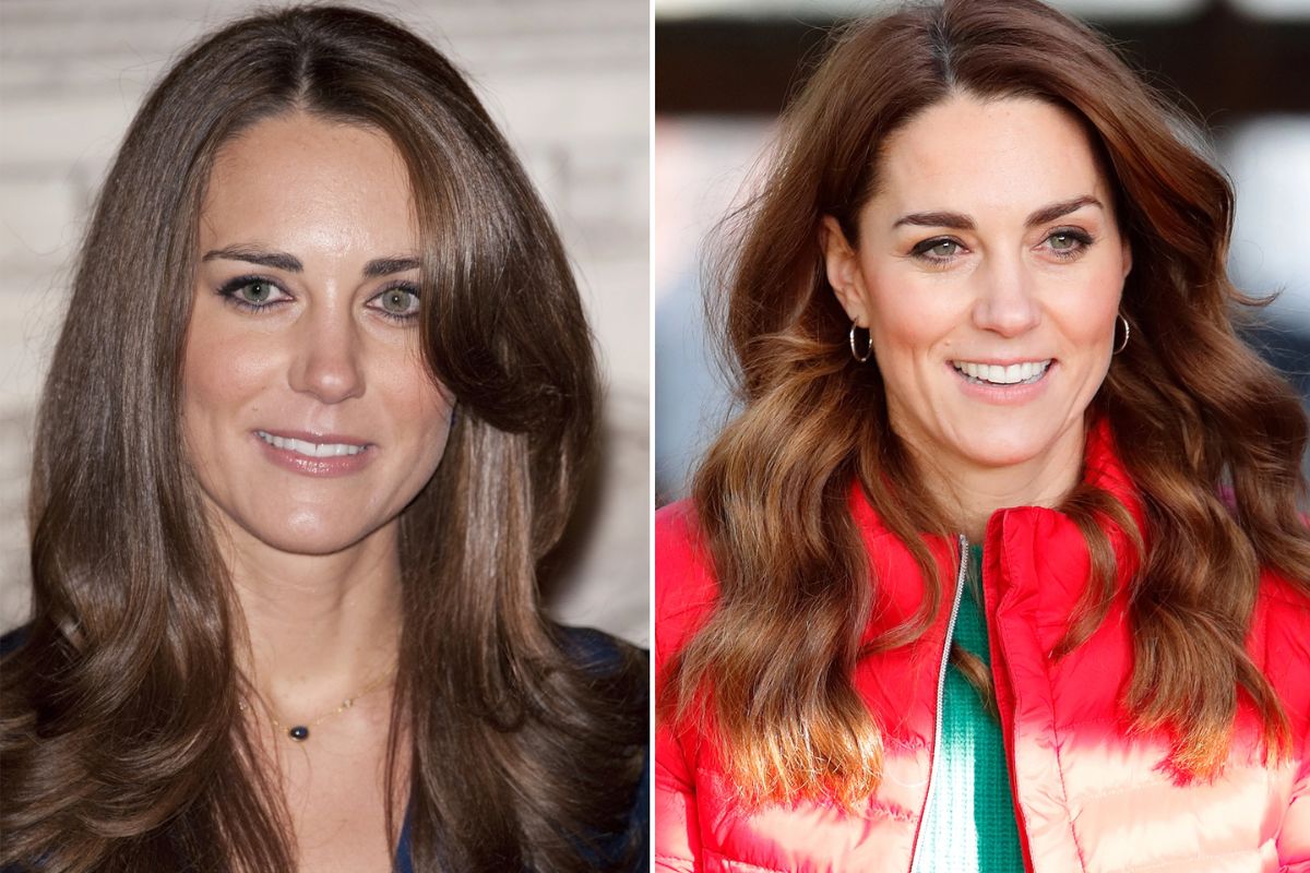 Kate Middleton Plastic Surgery 