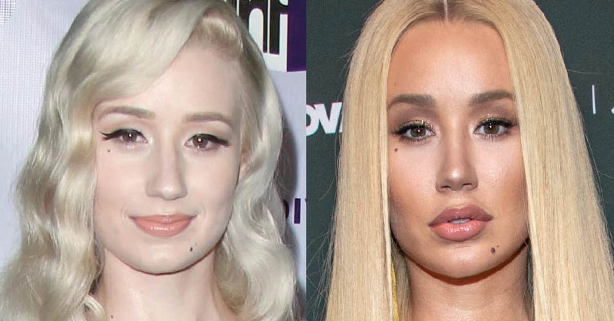 Iggy Azalea Before Plastic Surgery