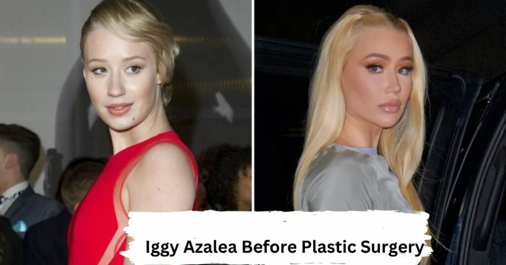 Iggy Azalea Before Plastic Surgery
