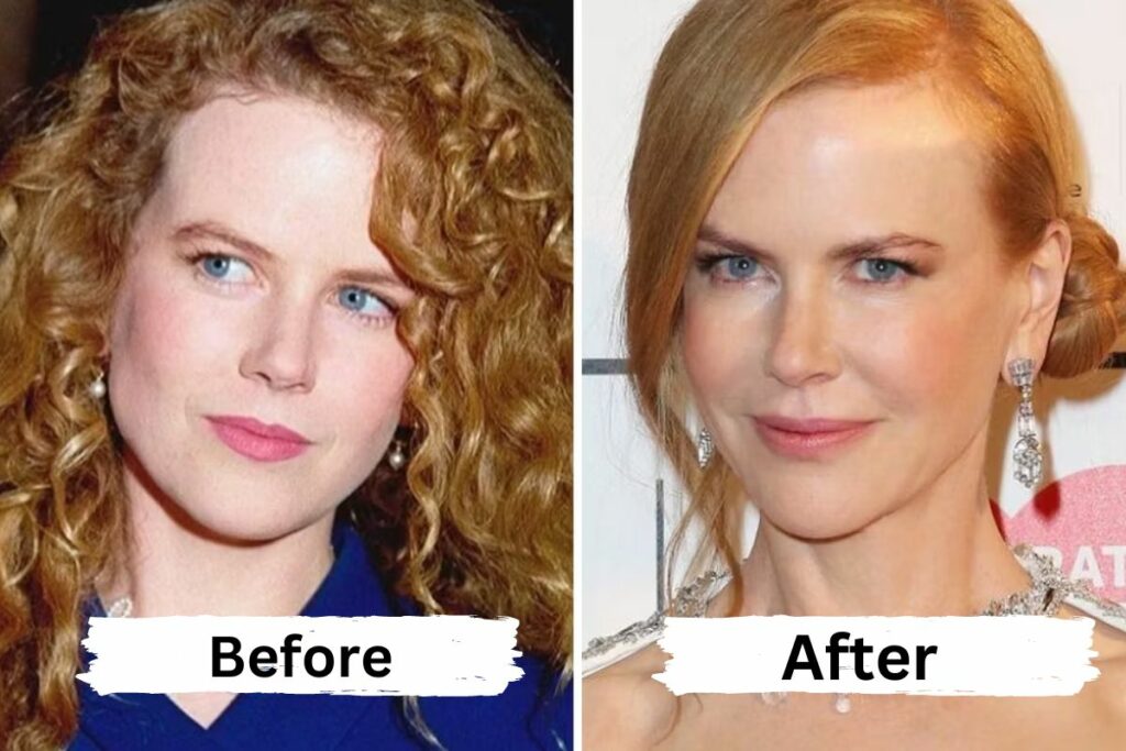 Nicole Kidman Plastic Surgery Before and After Journey